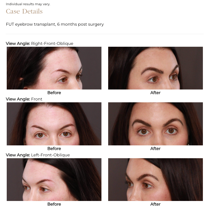 Eyebrow transplant at UFP Hair Restoration and Utah Facial Plastics